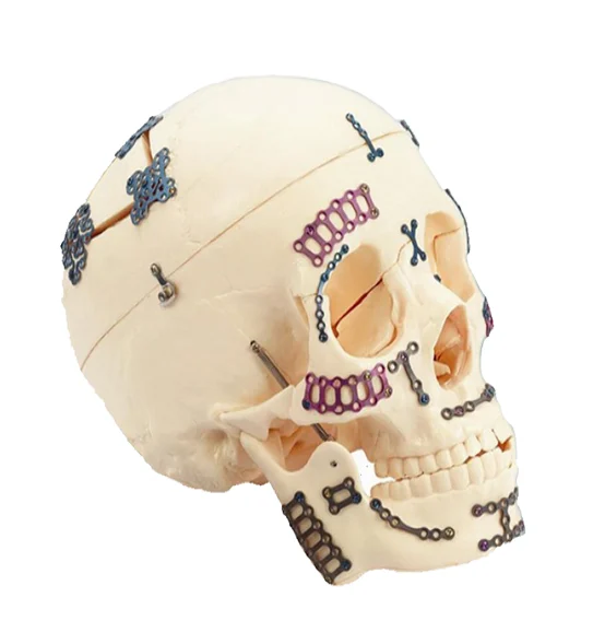 Cranio-Maxillofacial (CMF) Implants & Plating