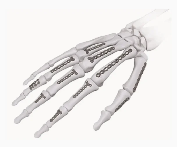 Professional Mini Fragment Plates & Screws (1.5mm - 2.4mm) fixation systems for hand and foot surgery. High-grade titanium & stainless steel plates, locking screws, and cortical screws. ZaBeel Industries